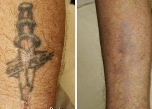 Different Involving Tattoo Removal