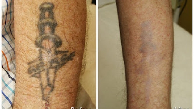 Different Involving Tattoo Removal