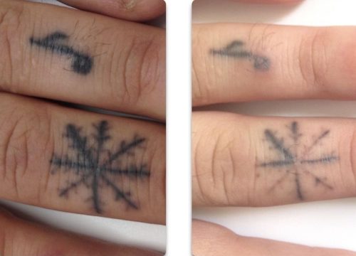 Tattoo Fade Using Tattoo Removing Creams