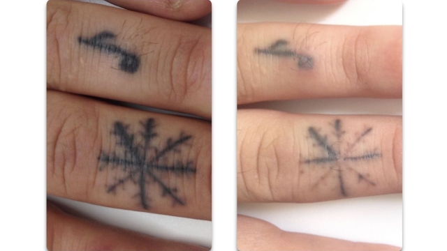 Tattoo Fade Using Tattoo Removing Creams