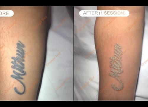 Celebrity Tattoo Regret – Megan Fox