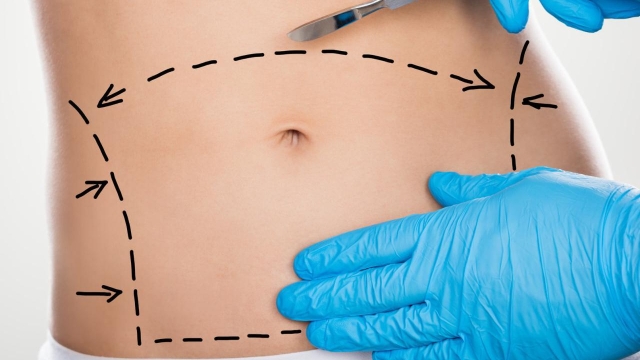 Tummy Tucks: Transform Your Abdomen with Abdominoplasty