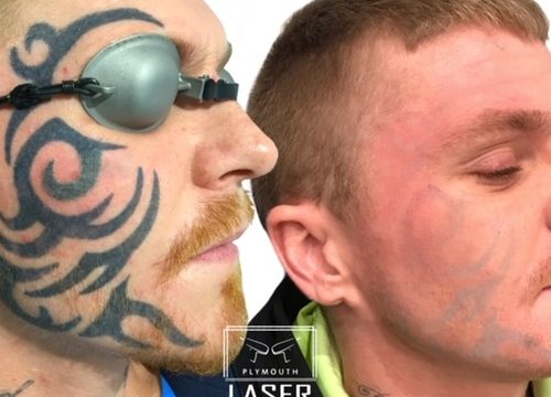 How To Invest In A Laser Tattoo Removal Cost