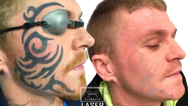 How To Invest In A Laser Tattoo Removal Cost