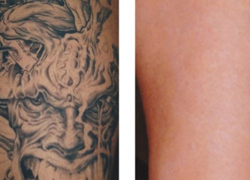 Tattoo Removal – Alternatives For Your Unwanted Tattoo