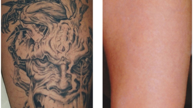 Tattoo Removal – Alternatives For Your Unwanted Tattoo