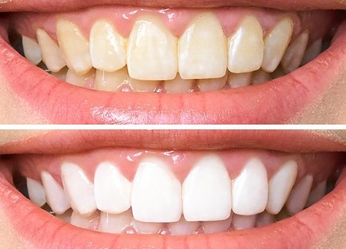 Bringing Back Your Dazzling Smile: Unveiling the Secrets of Teeth Whitening