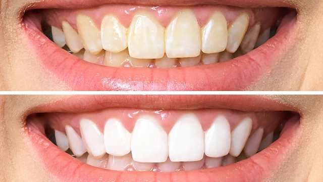 Bringing Back Your Dazzling Smile: Unveiling the Secrets of Teeth Whitening