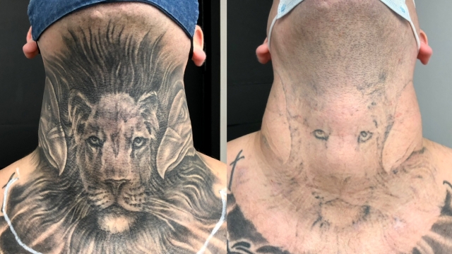 Laser Tattoo Removal Cost – Which Can Be Worth This Can?