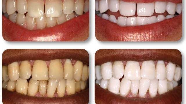 Sparkling Smiles: Unveiling the Secrets of Effective Teeth Whitening