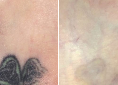What You Do Not Know About Tattoo Laser Removal!