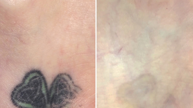 What You Do Not Know About Tattoo Laser Removal!